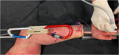 High-resolution ultrasound tendon-to-bone distances in partial and complete finger flexor A2 pulley ruptures simulated in human cadaver dissection: toward understanding imaging of partial pulley ruptures